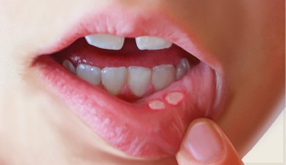  В случае наличия язв во рту возможно инфицирование при оральном сексе вирусными гепатитами и ВИЧ