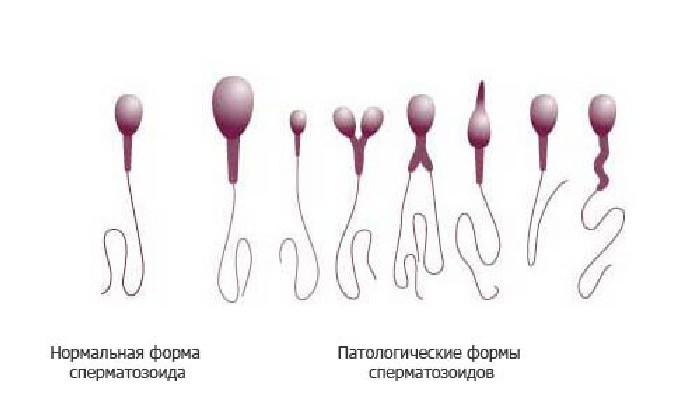 Тератозооспермия отражает уродства сперматозоидов в области их тел, шеек, хвостов. 