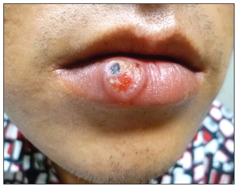  Первичный сифилис на губе