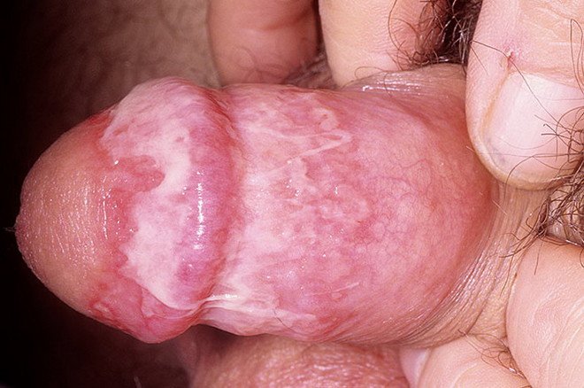 Внедрение в ткани гениталий дрожжевых грибков