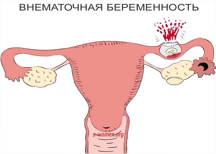 внематочная беременность при уреаплазмозе