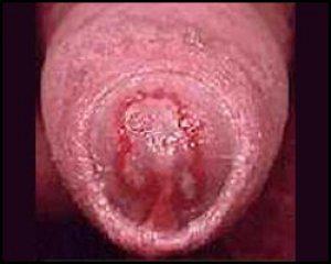 покраснение уретры при обострении хламидиоза