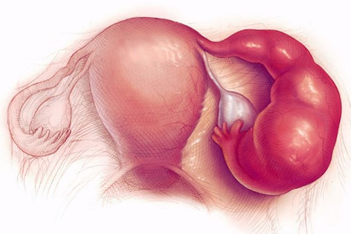 воспалительные процессы придатков матки при хламидиозе у женщин