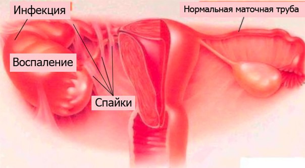 Воспаление маточных придатков при хламидиозе у женщин