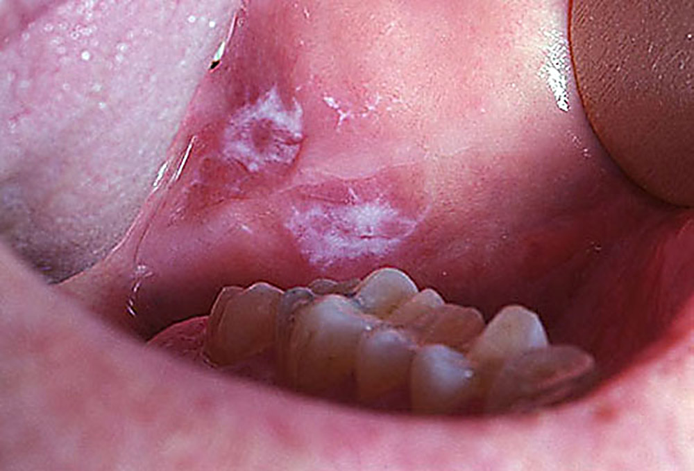  поражения рта при инфекциях мочеполовой системы