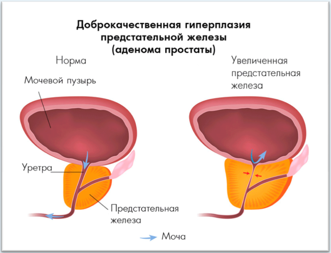 Высокий ПСА при простатите, аденоме простаты