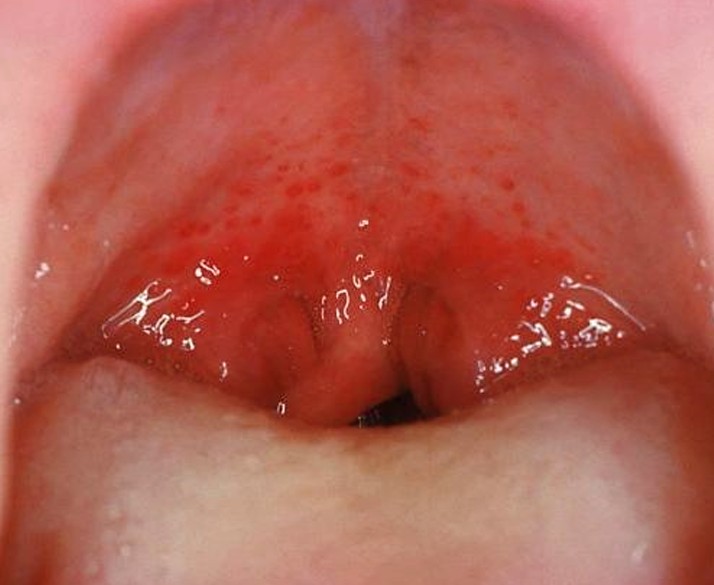 Слизистая оболочка гортани, небных миндалин и глотки при гонорее горла становится насыщенно красной (гиперемия)