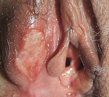 Одиночная безболезненная язвочка на половой губе при сифилисе