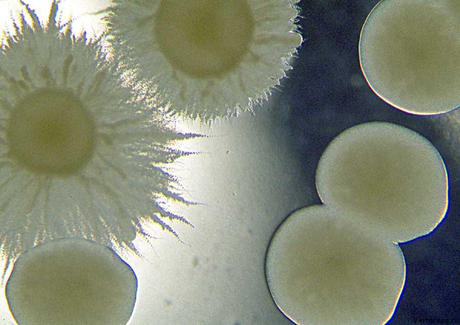 Кандидозный уретрит представляет собой грибковое воспалительное поражение слизистой оболочки уретры, вызванное грибками Candida.