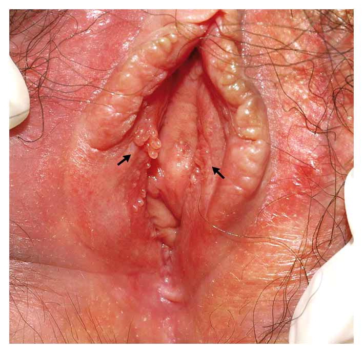 Воспаление сальной железы на половых губах у женщин