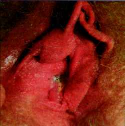 Воспалительная инфильтрация вульвы и половых губ, характеризующаяся их покраснением при трипере