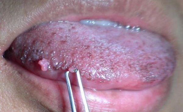 Можно заразится венерическими болезнями при оральном сексе thumbnail