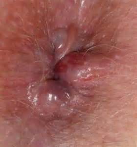 заражение анальной гонореей при попадании гнойного отделяемого из половых органов в трещины заднего прохода (чаще при геморрое)