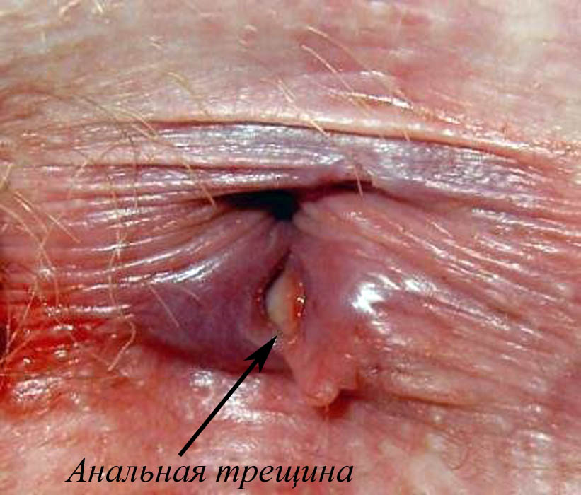 Появление в области ануса трещин и выростов в виде бородавок при анальной гонорее