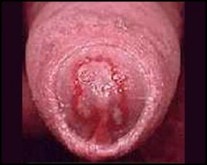 На головке полового члена появляются красные пятна, отечность тканей, зуд при трихомониазе