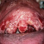  грибковое поражение полости рта
