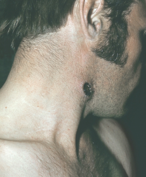  первичный шанкр сифилиса на шее у мужчины