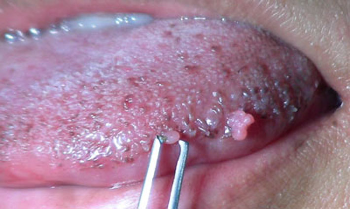 в некоторых случаях возможно появление узелков на слизистой рта.