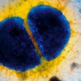 В мазке могут появляться патогенные микроорганизмы — гонококки при гонорее