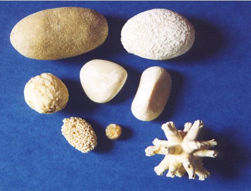 камни в почках при мочекаменной болезни