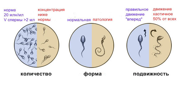 ухудшения качества спермы при уреаплазмозе